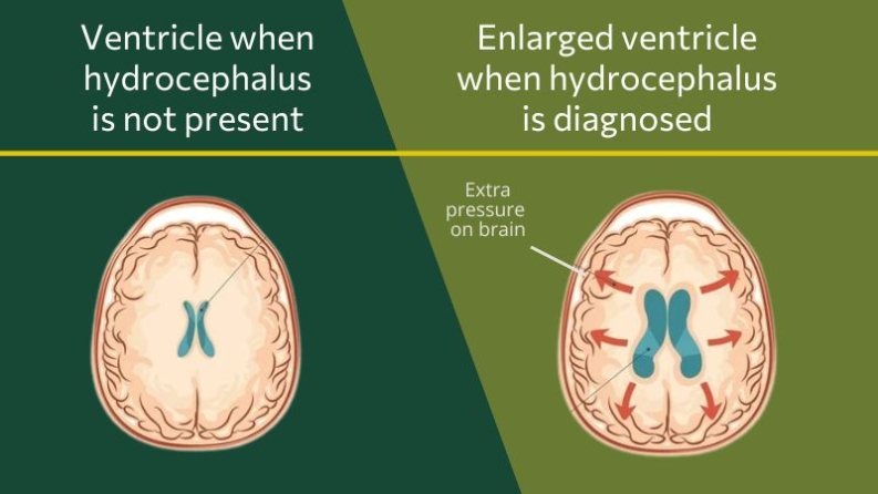 Ventricles become larger when an individual has hydrocephalus, so the size of ventricles pushes on the brain, causing excess pressure.